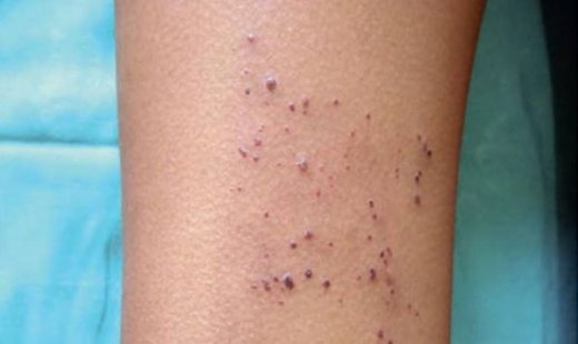 Νόσος Fabry: Τι είναι και τι μπορεί να προκαλέσει στα παιδιά