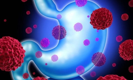 Καρκίνος του στομάχου: Μπορούμε να τον αποφύγουμε