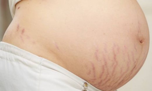 Ραγάδες στην εγκυμοσύνη; Μάθετε τα πάντα