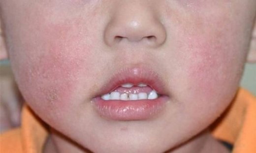 Έκζεμα σε βρέφη και παιδιά: Όλα όσα πρέπει να γνωρίζετε για να τα αντιμετωπίσετε