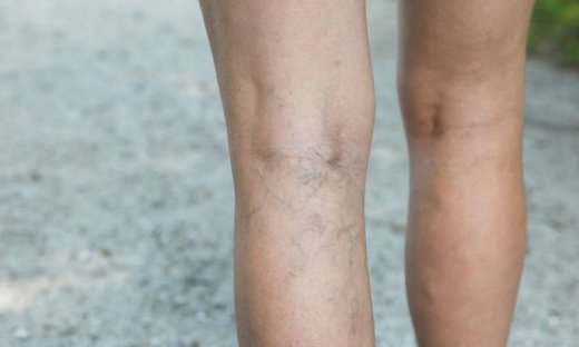 Πόδια που «καίνε»: Πώς θα ανακουφιστείτε το καλοκαίρι