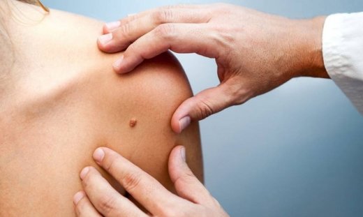 Επικίνδυνες ελιές: Πώς θα κάνετε αυτοεξέταση σε 5 βήματα