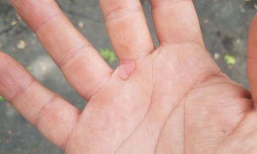 Φουσκάλες στο δέρμα: Αντιμετώπιση σε 3 βήματα