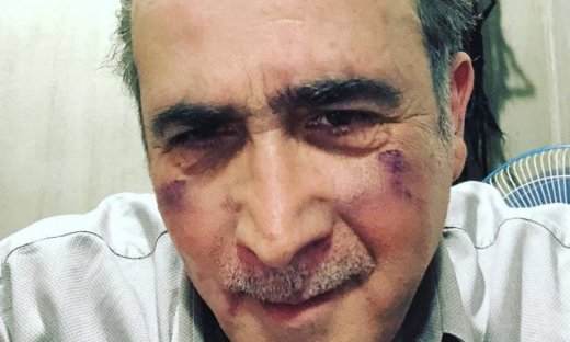 Με μώλωπες στο πρόσωπο ο Λάκης Λαζόπουλος. Τι συνέβη στον ηθοποιό;