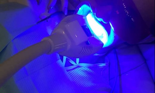 Μοντέλο του GNTM κάνει λεύκανση δοντιών και μας το δείχνει (Photo)