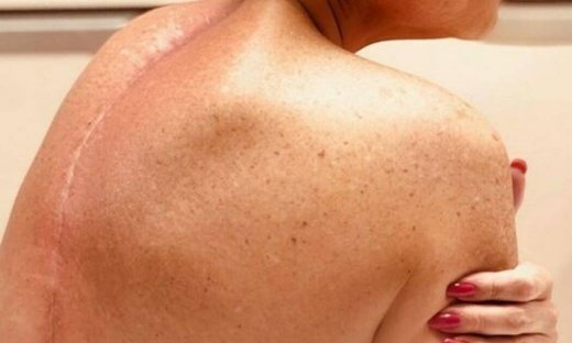 Σοκάρει πρώην παίκτρια ριάλιτι! Η ουλή στη σπονδυλική της στήλη ένα χρόνο μετά το χειρουργείο!