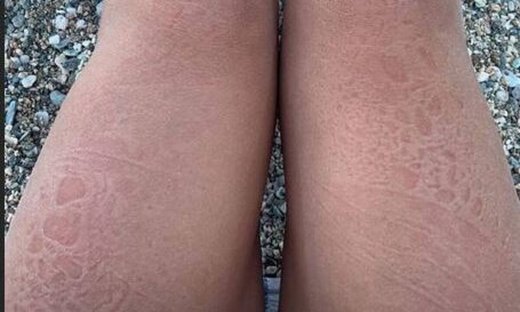 Απολαμβάνει τις διακοπές και φαίνεται από τα σημάδια από τα βότσαλα στα πόδια