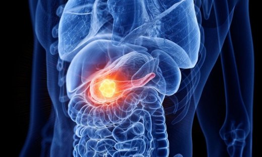 Η άσκηση ενισχύει την ανοσολογική απόκριση στον καρκίνο του παγκρέατος - μελέτη