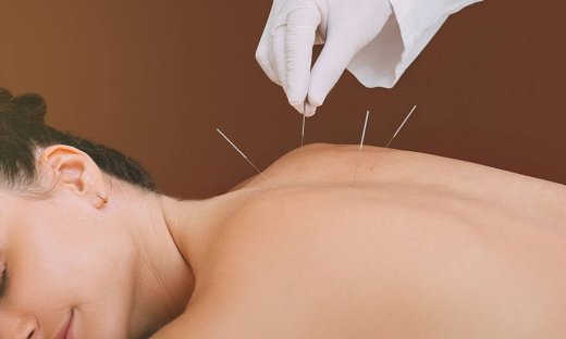 Ο βελονισμός μπορεί να βοηθήσει στην πρόληψη του διαβήτη τύπου 2, σύμφωνα με μελέτη