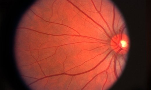 Ηλικιακή εκφύλιση ωχράς κηλίδας: Ο ρόλος του τεχνητού φωτισμού