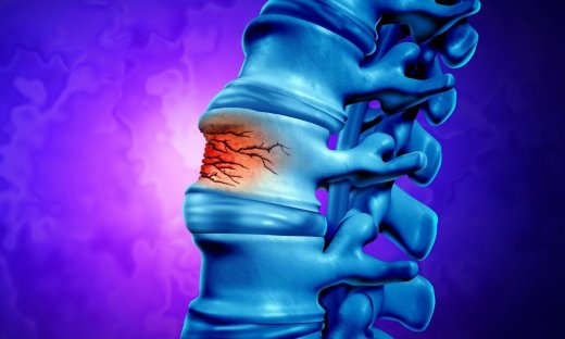 Οστεοπορωτικό κάταγμα: Ποιοι ανήκουν στην κατηγορία υψηλού κινδύνου