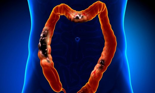 Καρκίνος παχέος εντέρου: Το πρώτο εμβόλιο είναι γεγονός