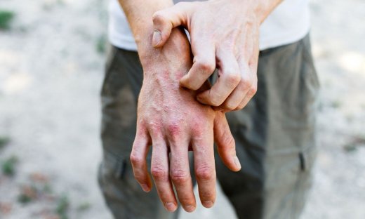 Φαγούρα στα χέρια: Πώς θα καταλάβετε αν είναι έκζεμα