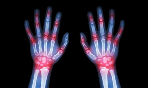 Ρευματοειδής αρθρίτιδα: Το φάρμακο που την προλαμβάνει