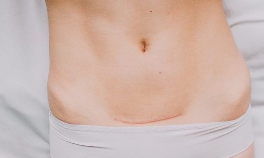 Ουλές μετά την καισαρική: Συμβουλές για την βελτίωση της εμφάνισής τους