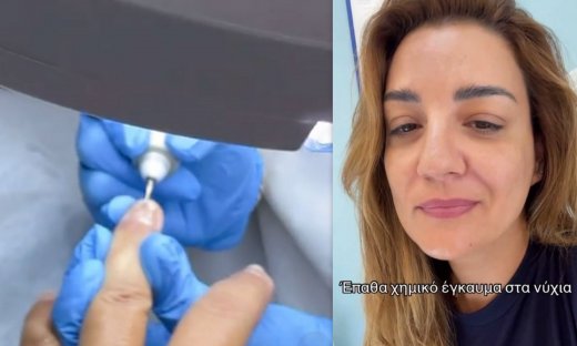 Ελίνα Παπίλα: Έπαθε χημικό έγκαυμα στα νύχια - «Έβλεπα το νύχι μου να ξεκολλάει... Τι θα κάνω;»