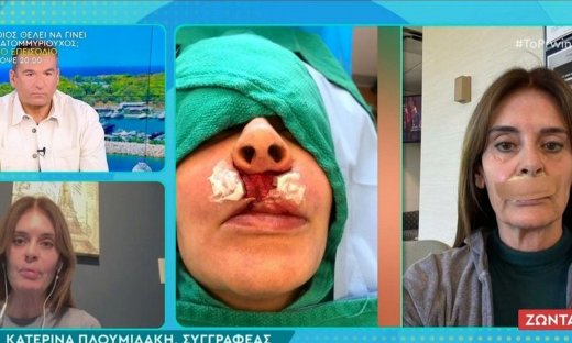 Σοκάρει η Πλουμιδάκη: Παίρνουν κάθε ενάμιση μήνα λίπος από τον γλουτό για να μου φτιάξουν τα χείλη