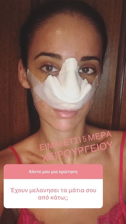 Η Τζούλια από το Power of love δείχνει το πρόσωπο της πέντε ημέρες μετά την πλαστική στη μύτη