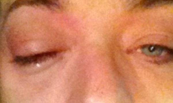 Με μαυρισμένο μάτι γνωστός τραγουδιστής μετά από επίθεση! (φωτό)