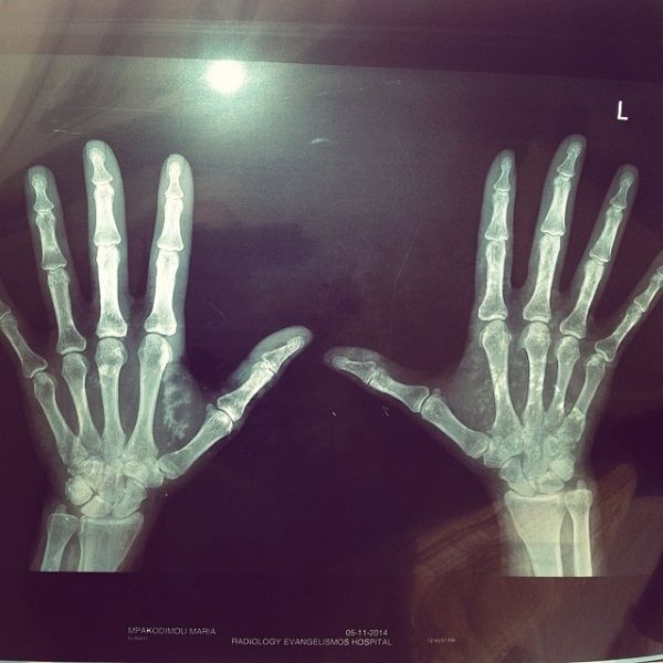 Ελληνίδα παρουσιάστρια πόσταρε την ακτινογραφία των χεριών της στο Instagram