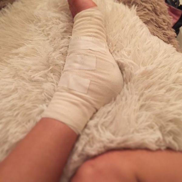 Η άτυχη στιγμή μοντέλου. Το ατύχημα και οι γάζες στο πόδι της