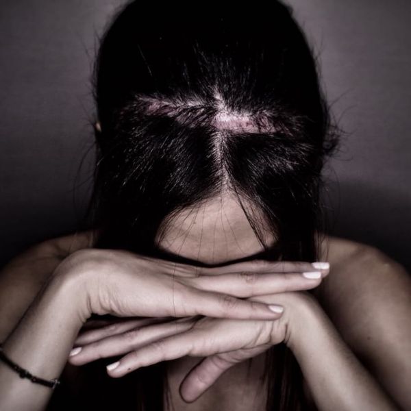 Η Βούλγαρη συγκλονίζει – Έναν χρόνο μετά την επέμβαση στο κεφάλι δείχνει την τομή και μιλάει για όλα