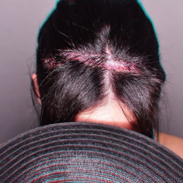 Η Βούλγαρη συγκλονίζει – Έναν χρόνο μετά την επέμβαση στο κεφάλι δείχνει την τομή και μιλάει για όλα