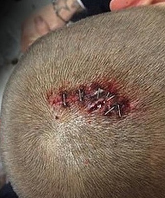 Σόκαρε τους πάντες όταν ανέβασε στο instagram τα ράμματα που έκανε στο κεφάλι του!