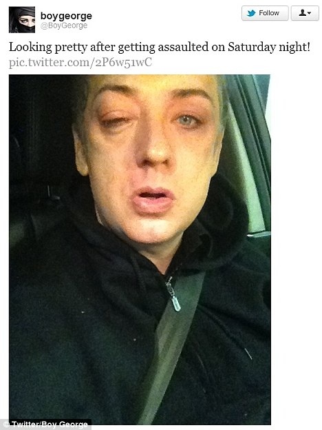 Με μαυρισμένο μάτι γνωστός τραγουδιστής μετά από επίθεση! (φωτό)