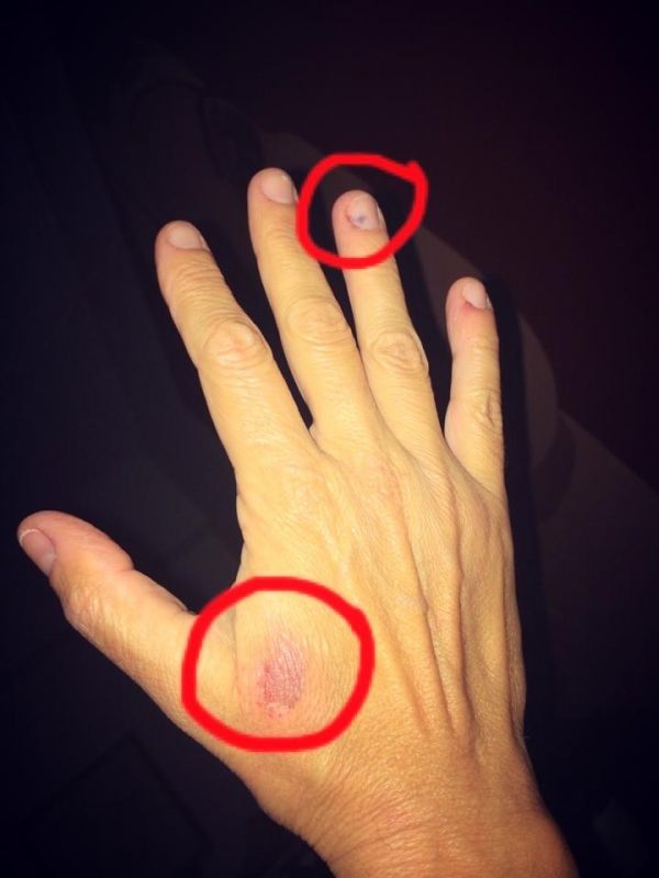 Ποιος τη μάτιασε; Έκαψε το χέρι της και έπιασε το δάχτυλό της στην πόρτα!