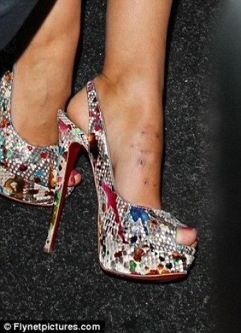 Απίστευτο! Οι γόβες της κατέστρεψαν το πόδι!