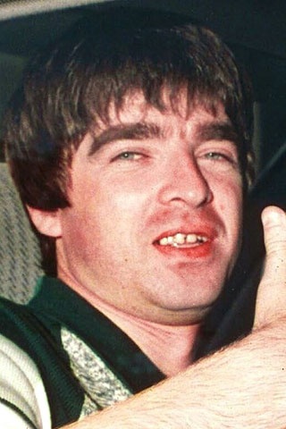 Διάσημα δόντια: Πριν και μετά