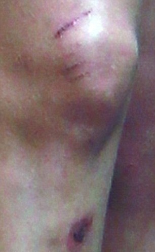 Έπεσε και χτύπησε άσχημα!